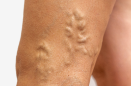 EJERCICIO FISICO PARA LAS VARICES