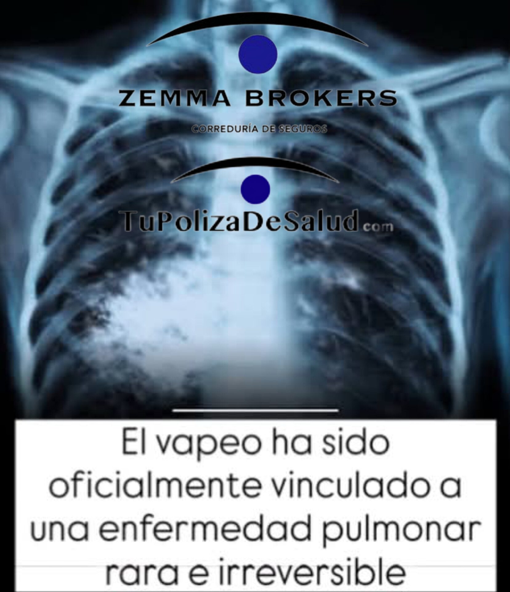 Alertan sobre el “pulmón de palomitas”: una enfermedad pulmonar irreversible vinculada al vapeo